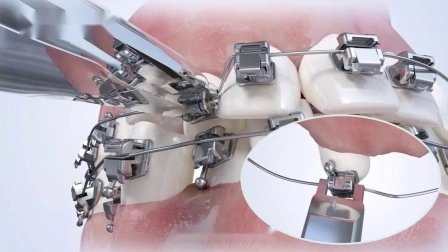 Fabrication de produits orthodontiques Produit de supports de dents auto-ligaturants passifs orthodontiques
